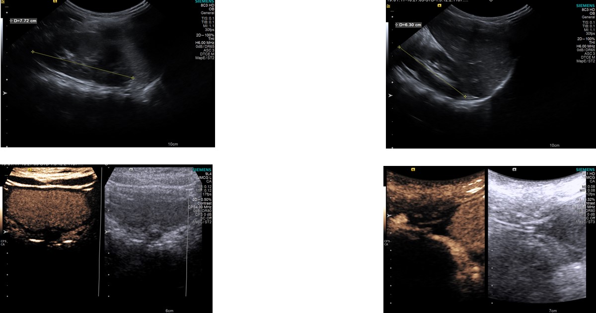 ultrazvucna-kontrastna-mikciona-urografija