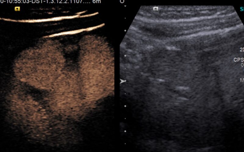 indikacije-za-kontrastnu-ultrazvučnu-mikcionu-urografiju- cistografiju-ultrazvucna-ordinacija-polina